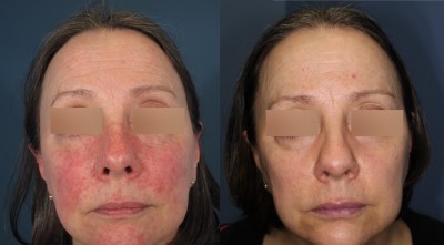 Rosacea, Before and After treatment. Image courtesy Dr. Jason Rivers