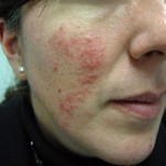 Rosacea with facial redness and pimples