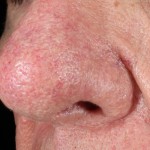 Men get rosacea - Rhinophyma - L view nose, Dr. Jerry Tan