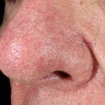 Up close image of person's nose with rosacea and skin thickening.