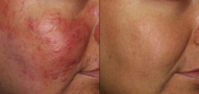 Rikki's rosacea before and after treatment