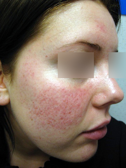 Up close image of person's face with rosacea. Eyes are blurred out.