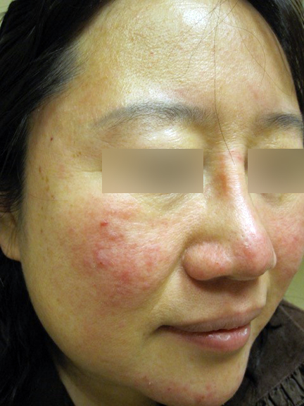 Up close image of person's face with rosacea. Eyes are blurred out.