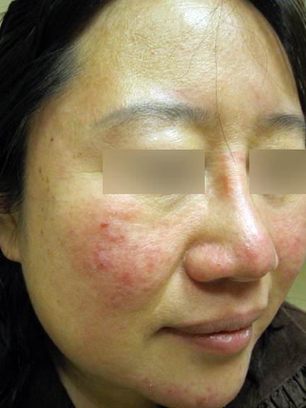 Bouffées de chaleur et rougeurs au visage - Rosacea