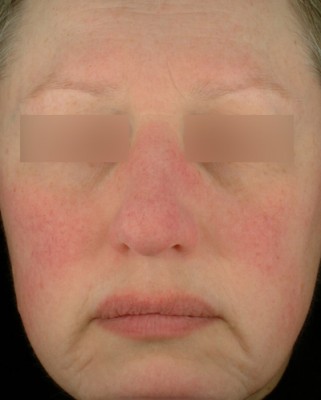 Up close image of person's face with rosacea. Eyes are blurred out.