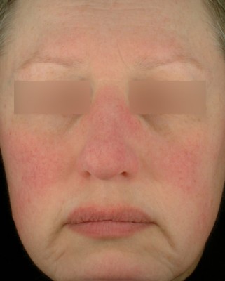 Bouffées de chaleur et rougeurs au visage - Rosacea