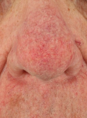 Image rapprochée du nez d'une personne présentant une rosacée et un épaississement de la peau.