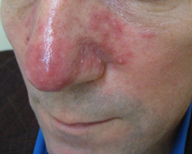 Up close image of person's nose with rosacea and pimples