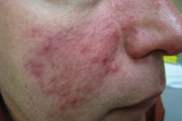 Up close image of person's cheek and nose with rosacea and pimples.