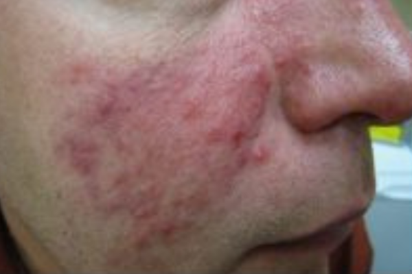 Rougeurs au visage et boutons - Rosacea