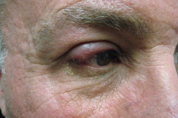 Up close image of a man's irritated eye.