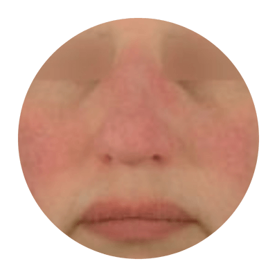 Image rapprochée du visage d’une personne atteinte de rosacée.