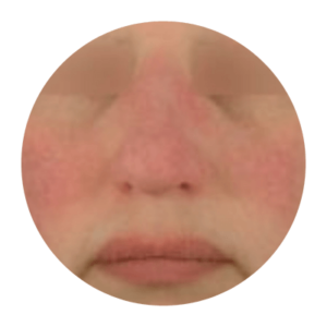 Up close image of person's face with rosacea.