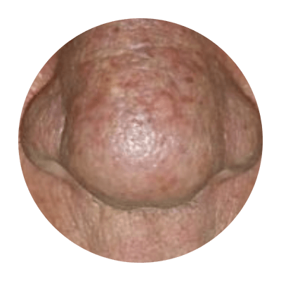 Image rapprochée du nez d'une personne atteinte de rosacée.