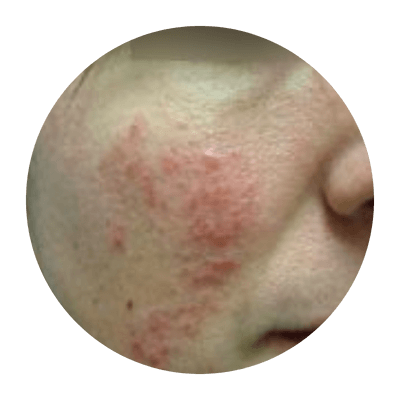 Image rapprochée de la joue d’une personne atteinte de rosacée.