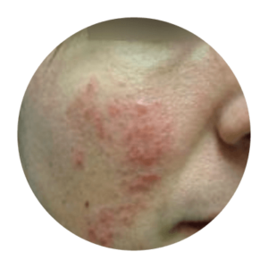 Up close image of person's cheek with rosacea.