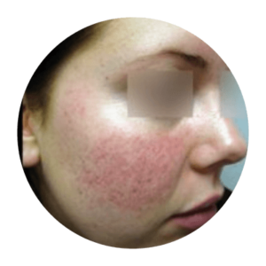 Up close image of person's cheek with rosacea.