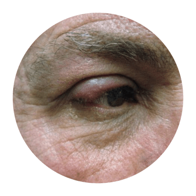 Image rapprochée du contour des yeux d'une personne atteinte de rosacée.