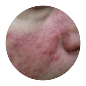 Up close image of person's cheek with rosacea.