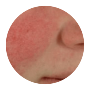 Up close image of person's cheek with rosacea.