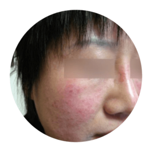 Up close image of person's cheek with rosacea.