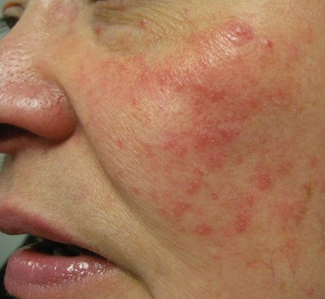 Image rapprochée de la joue d'une personne atteinte de rosacée