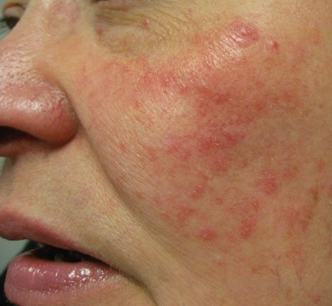 Up close image of person's cheek with rosacea