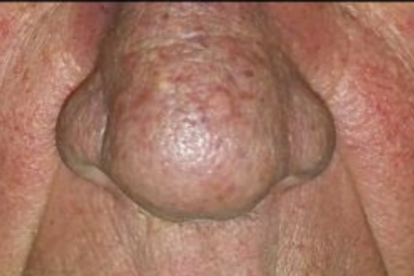 Image rapprochée du nez d'une personne présentant une rosacée et un épaississement de la peau.