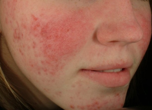 Up close image of person's cheek with rosacea