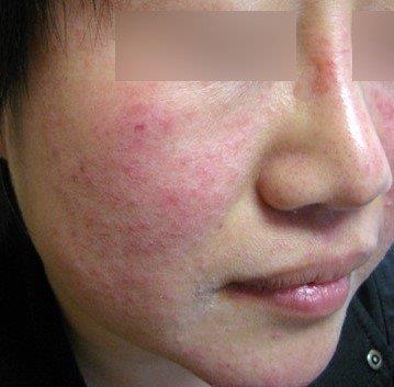 Up close image of person's cheek with rosacea. 