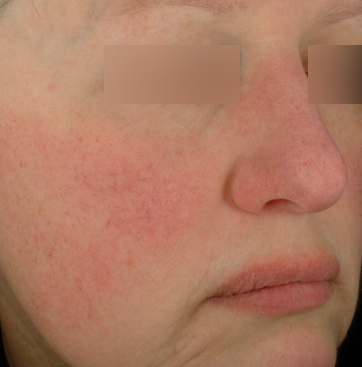 Up close image of person's cheek with rosacea.